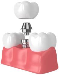 Имплантация Straumann с циркониевой коронкой