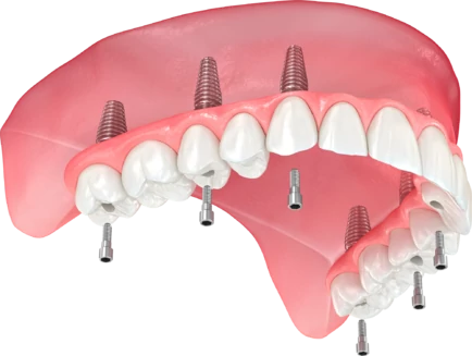 Straumann Pro Arch